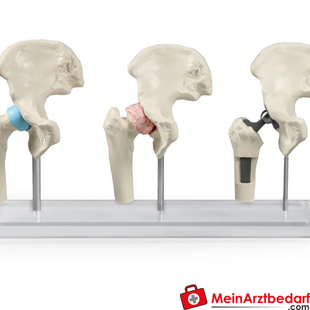 Erler-Zimmer Hüft-Implantat-Modell.