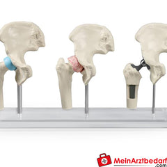 Erler-Zimmer Hüft-Implantat-Modell.