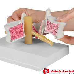Erler-Zimmer Osteoporose.