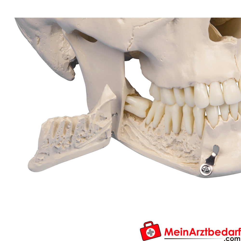 Erler-Zimmer Dental-Schädel, 4-teilig.