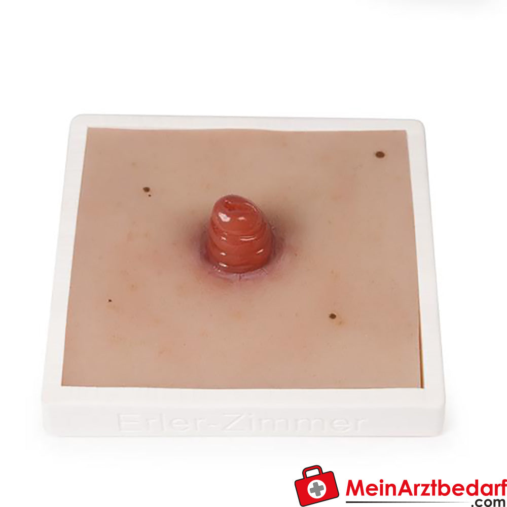 Erler-Zimmer Wundmoulage inkl. Stativ.