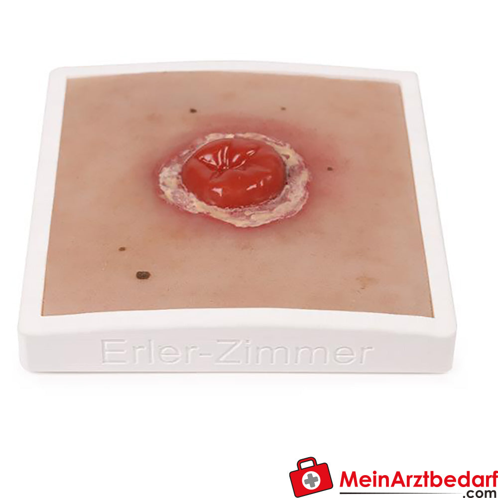Erler-Zimmer Wundmoulage inkl. Stativ.