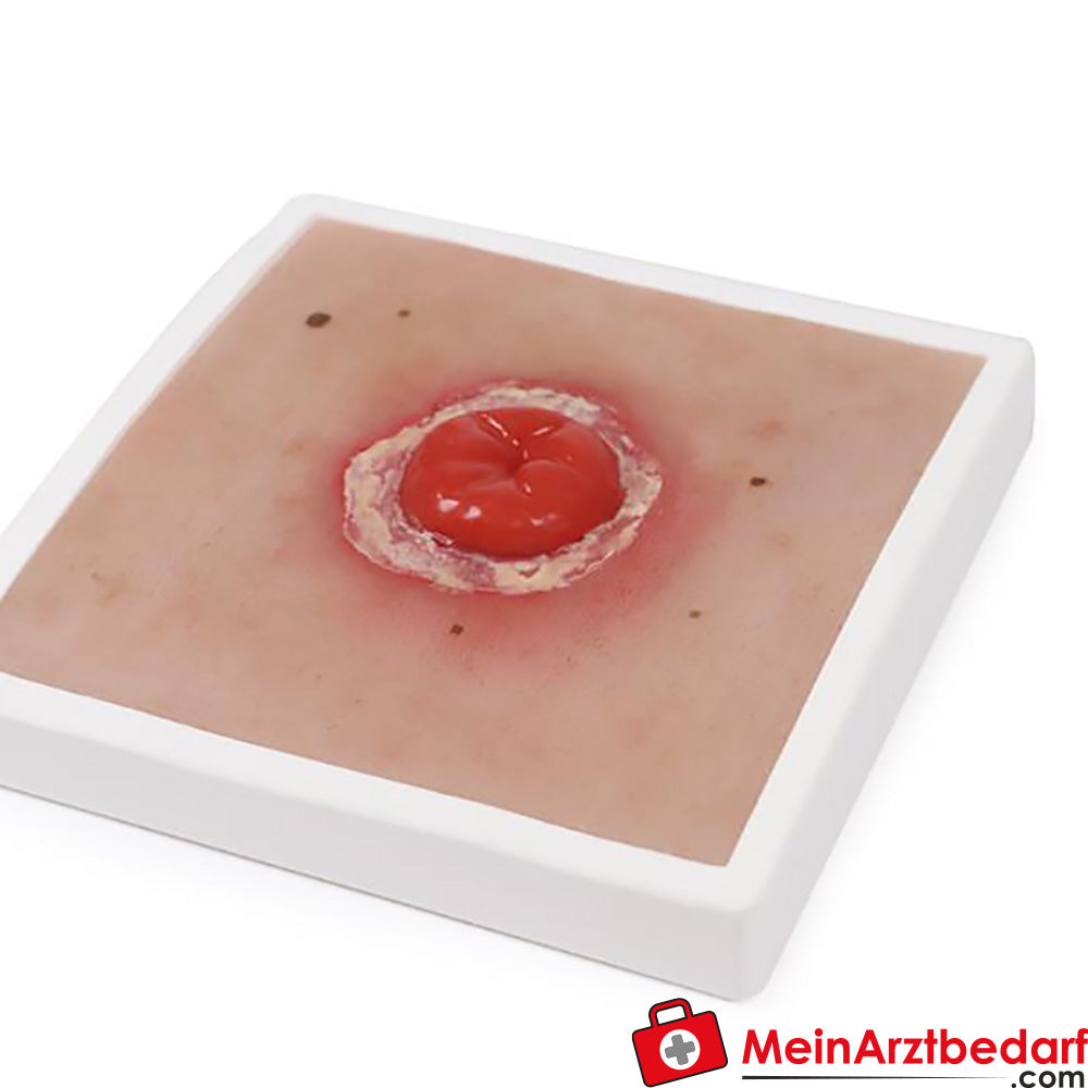 Erler-Zimmer Wundmoulage inkl. Stativ.